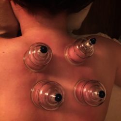 close up of cupping therapy with four placed cups